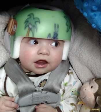 Baby wearing cranial band