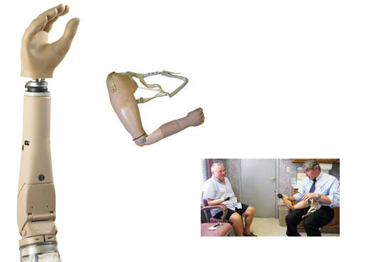 interscapular-thoracic prostheses